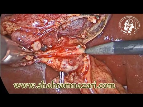 Cholecystektomia laparoskopowa 