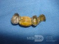 Proteza dentystyczna znaleziona w jelicie czczym (7 z 9)