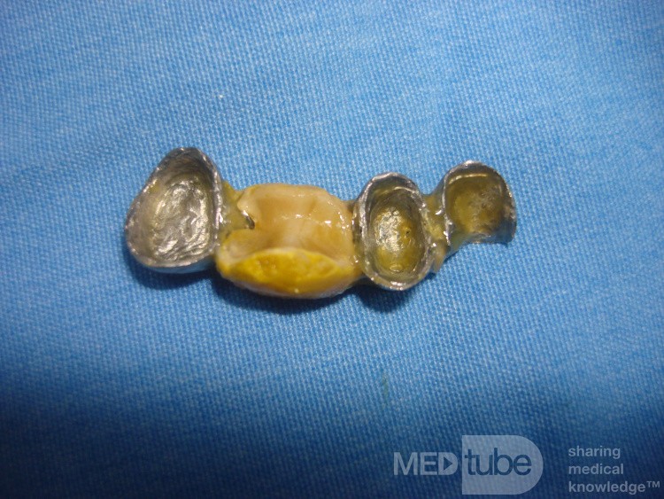 Proteza dentystyczna znaleziona w jelicie czczym (7 z 9)