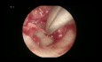 Endoskopowa tympanoplastyka z użyciem PORP w przewlekłym śluzowym zapaleniu ucha środkowego