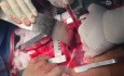 Ascending Aorta to Descending Aorta Bypass for Coarctation and Interupted Aortic Arch
