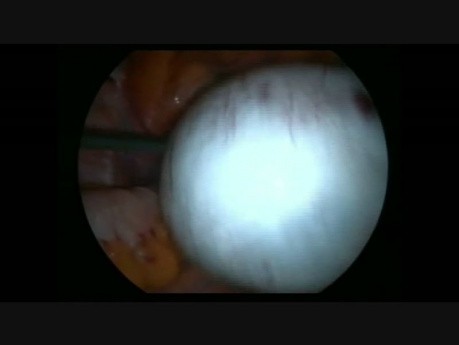 Laparoskopia- skręt przydatków z powodu torbeli jajnikowej i okołojajnikowej