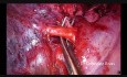 Wideotrakoskopowa lobektomia z jednego cięcia po torakotomii