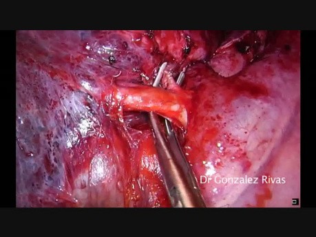 Wideotrakoskopowa lobektomia z jednego cięcia po torakotomii