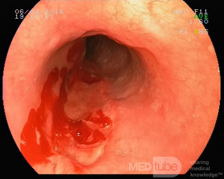 Owrzodzenia przełyku, przypadek (foto 4/4)