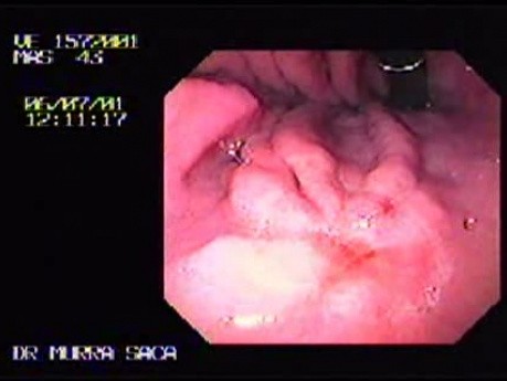 Wczesny rak żołądka z komórkami sygnetowatymi - endoskopia (1 z 3)