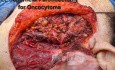 Onkocytoma lewej ślinianki przyusznej 