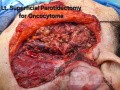 Onkocytoma lewej ślinianki przyusznej 