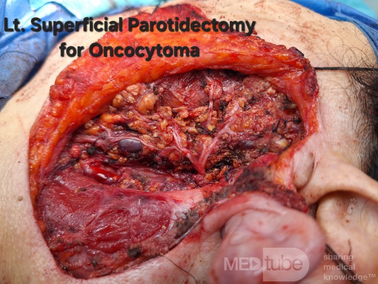 Onkocytoma lewej ślinianki przyusznej 