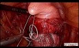 Laparoskopowa sakrokolpopeksja u pacjentki z wypadającym sklepieniem pochwy