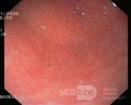 Endoskopia - przewlekłe zapalenie błony śluzowej żołądka