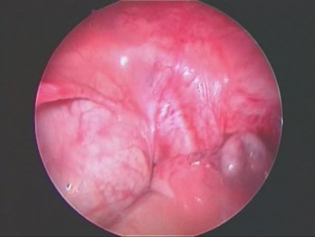 Appendektomia laparoskopowo