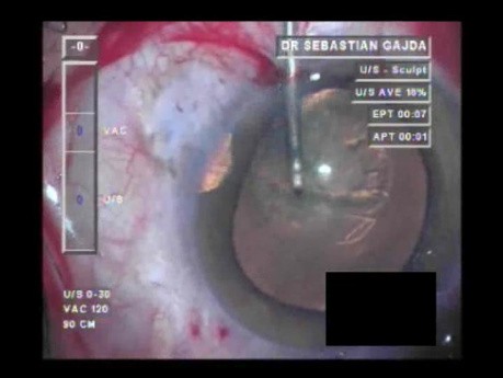 Operacja zaćmy w oku z wykonaną trabekulektomią 1