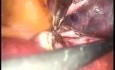 Laparoskopowe usunięcie jajowodu z powodu ciąży ektopowej