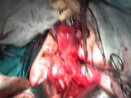 Radykalna chirurgia macicy - przecięcie kanału moczowodu