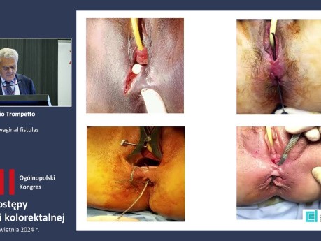 Przetoki odbytniczo-pochwowe (Rectovaginal Fistulas)