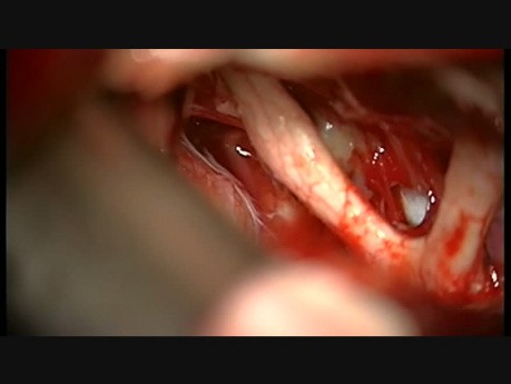 Tętniak ocznego segmentu lewej tętnicy szyjnej wewnętrznej