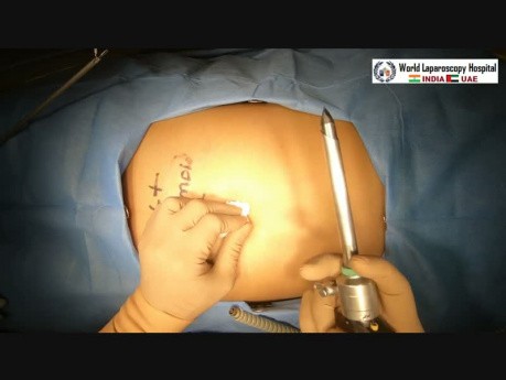 Operacja laparoskopowa torbieli dermoidalnej (skórzastej) lewego jajnika. 