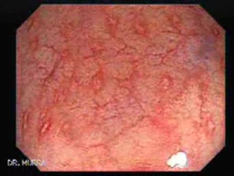 Zapalenie jelita grubego w przebiegu choroby Leśniowskiego-Crohna (1 z 3)
