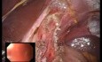 Operacja laparoendoskopowa LESS: miotomia Hellera i fundoplikacja przednia