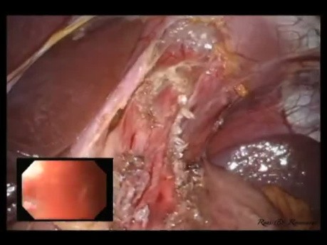 Operacja laparoendoskopowa LESS: miotomia Hellera i fundoplikacja przednia