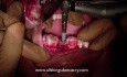 Komputerowo Wspomagany Zabieg Implantacji - Umieszczenie Implantu - ostatecznie