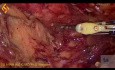 Niska przednia laparoskopowa resekcja odbytnicy z powodu raka odbytnicy
