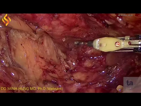 Niska przednia laparoskopowa resekcja odbytnicy z powodu raka odbytnicy