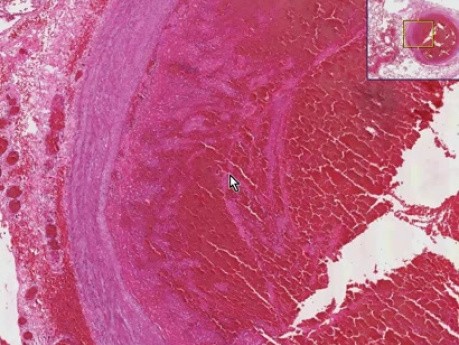 Zator spowodowany zakrzepem - histopatologia płuc