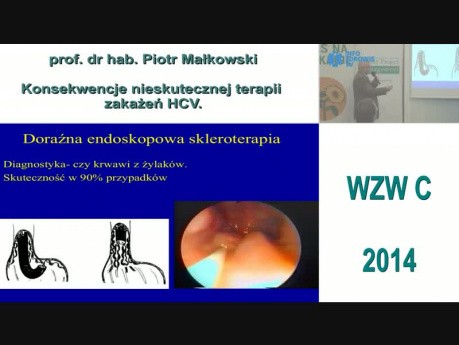 Konsekwencje nieskutecznej terapii zakażeń HCV - prof. dr hab. Piotr Małkowski