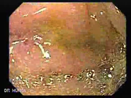 Rak jajnika z przerzutami do żołądka i dwunastnicy - szybka ocena opuszki dwunastnicy