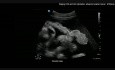 Przedoperacyjne ultrasonograficzne objawy zaawansowanego raka jajnika z odpowiadającymi nagraniami video z operacji, oraz predykcja ryzyka powikłań planowanej cytoredukcji.