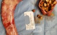 Efekt rękawowej resekcji żołądka i cholecystektomii- usunięta część żołądka i złogi żółciowe