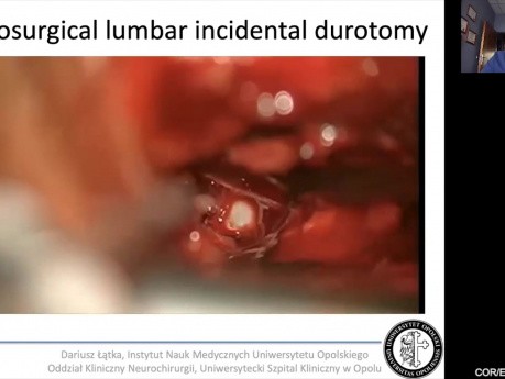 Incydentalna durotomia – recepta ratunkowa