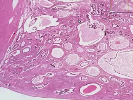 Polip endometrium - histopatologia