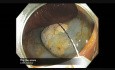 Kolonoskopia: endoskopowa resekcja śluzówkowa płaskiej zmiany