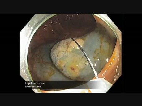 Kolonoskopia: endoskopowa resekcja śluzówkowa płaskiej zmiany