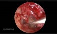 Oburęczna endoskopowa stapedektomia 