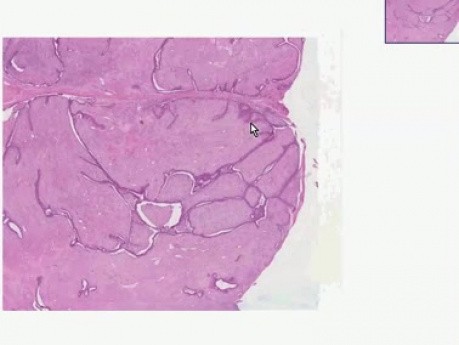 Gruczolakowłókniak - histopatologia - pierś