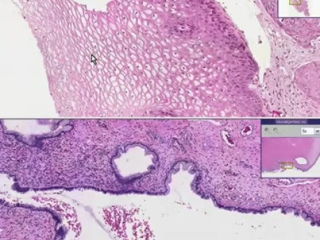 Rak płaskonabłonkowy - histopatologia - szyjka macicy