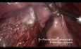 Miomektomia u pacjentki z mięśniakiem cieśni i szyjki macicy