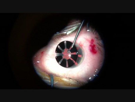 Wszczepienie częściowego implantu tęczówki z usunięciem zaćmy w oku z wrodzoną beztęczówkowością, zaćmą, wysoką krótkowzrocznością i oczopląsem