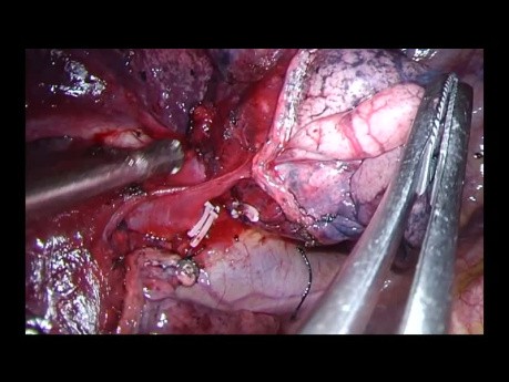 Segmentektomia przednia prawostronna S3 metodą uniportal VATS