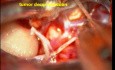 Mikrochirurgiczne usunięcie osłoniaka nerwu trójdzielnego