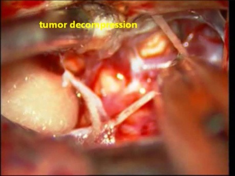 Mikrochirurgiczne usunięcie osłoniaka nerwu trójdzielnego