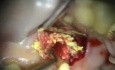 Mikrochirurgia endo-perio