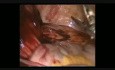 Laparoskopowa operacja guza jamy brzusznej -gossypiboma
