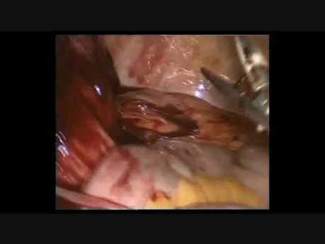 Laparoskopowa operacja guza jamy brzusznej -gossypiboma