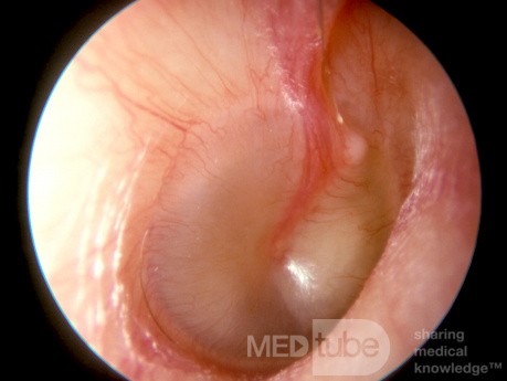 Śluzowe zapalenie ucha środkowego 