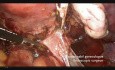 Całkowita histerektomia laparoskopowa przy użyciu urządzenia BiCision